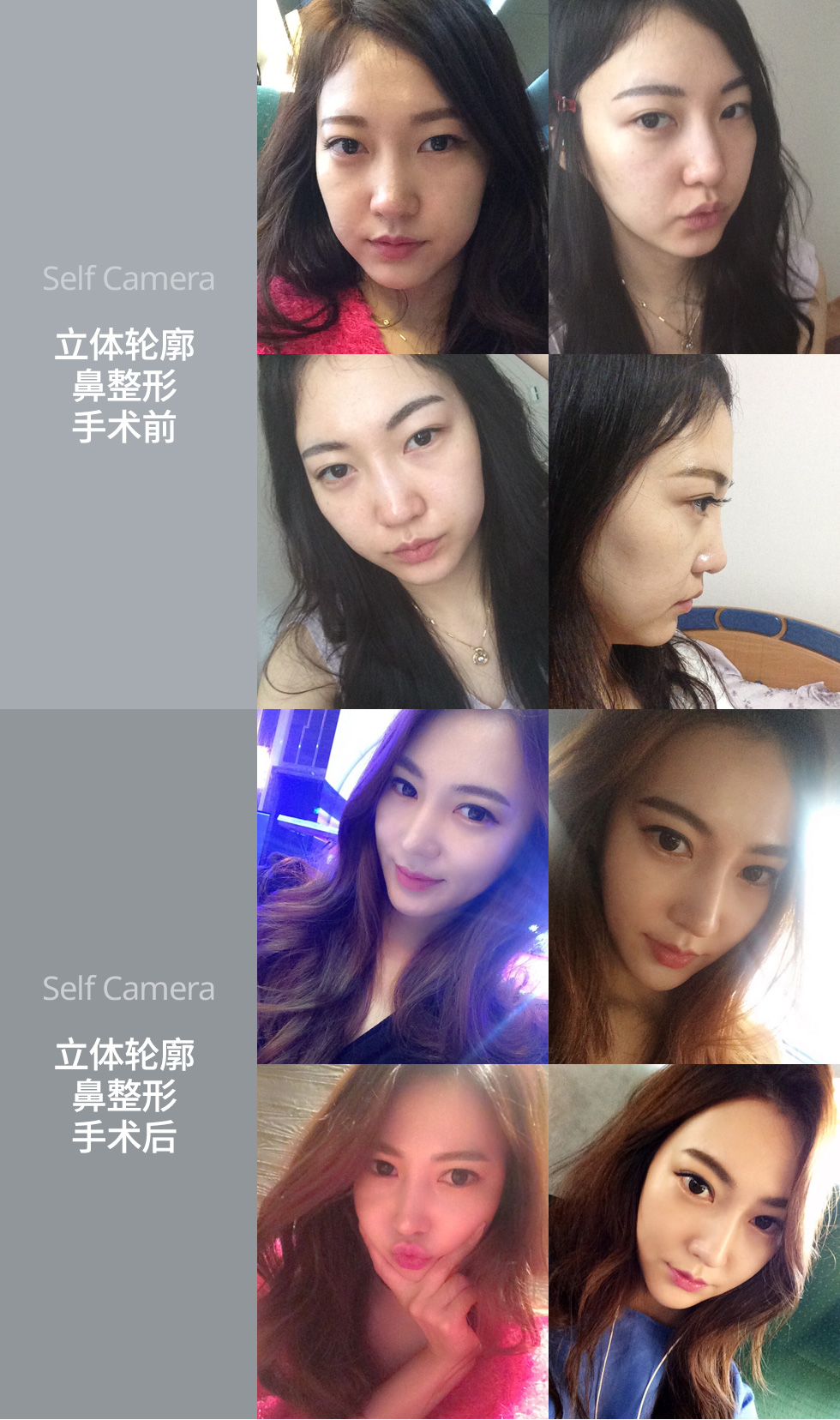 树立面部的中心 立体轮廓鼻整形手术