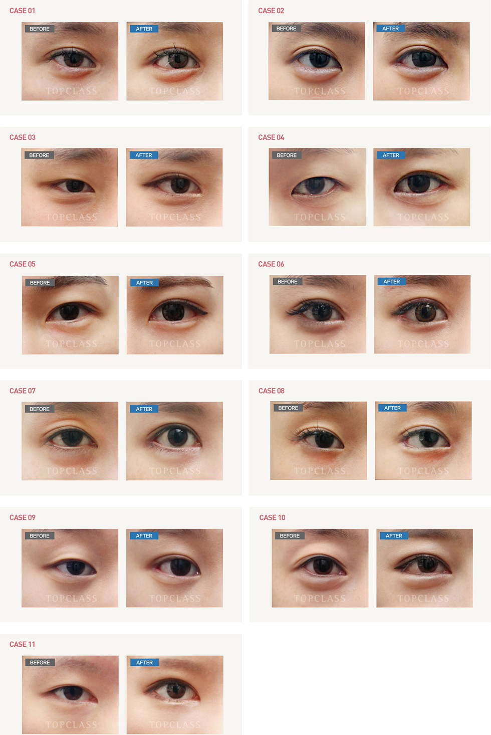 魔力开前眼角（开上眼角）手术前/后