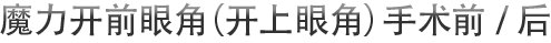 魔力开前眼角（开上眼角）手术前/后
