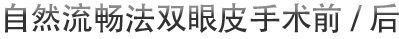 自然流畅法双眼皮手术前/后