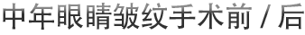 中年眼睛皱纹手术前/后