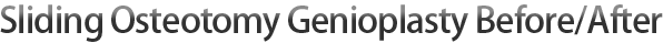 Sliding Osteotomy Genioplasty Before/After