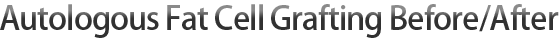 Autologous Fat Cell Grafting Before/After