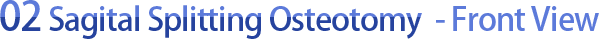 02 Sagital Splitting Osteotomy - Front View