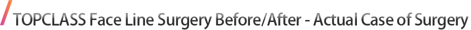 TOPCLASS Face Line Surgery Before/After - Actual Case of Surgery