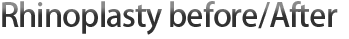隆鼻手术前/后