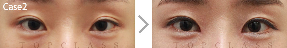 Case2 Magic Inner Corner Fold Removal（Canthoplasty）Before/After