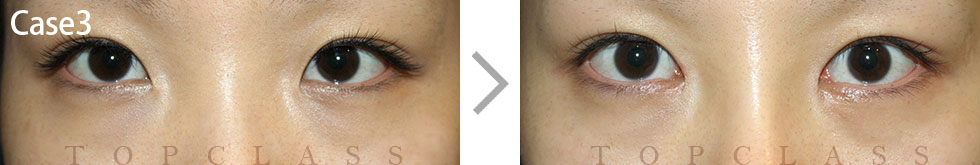 Case3 Magic Inner Corner Fold Removal（Canthoplasty）Before/After