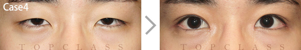 Case4 Multi Outer Corner Extension（Lateral Canthoplasty）Before/After
