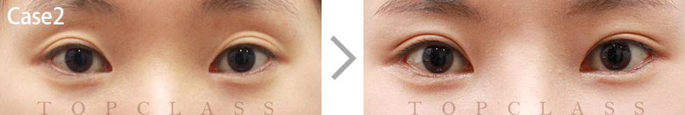 Case2 Revisional Double Eyelid Surgery Before/After