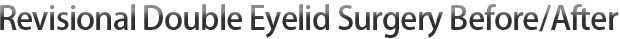 Revisional Double Eyelid Surgery Before/After