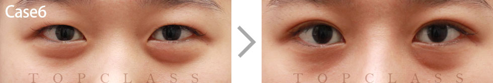Case6 Natural Adhesion Double Eyelid Technique Before/After